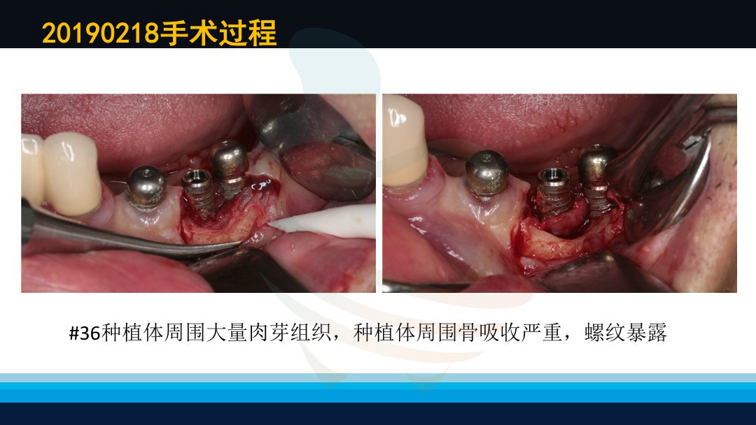 左下后牙区戴牙一年半后种植体周围炎一例