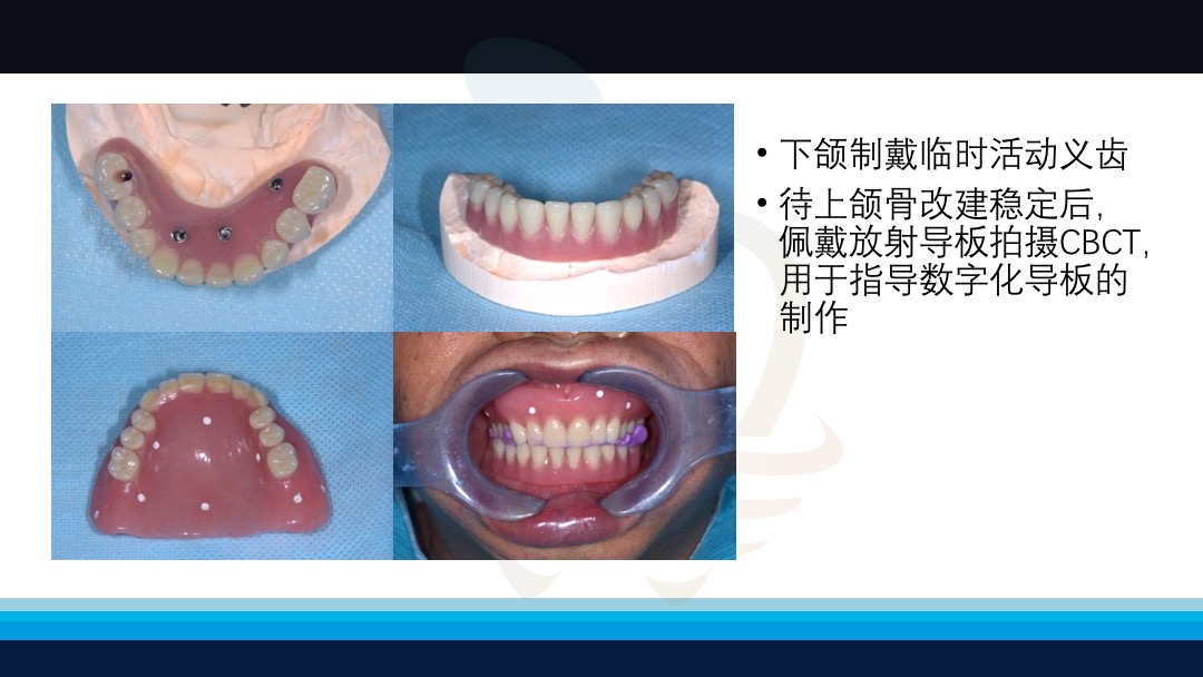 无牙颌种植修复病例一例
