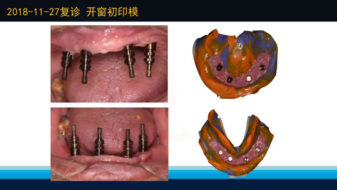 数字化印模无牙颌种植修复