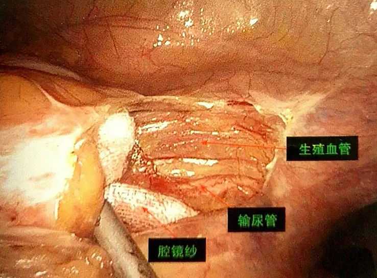 【腹腔镜篇】结肠切除手术——结肠切除的最佳手术方式