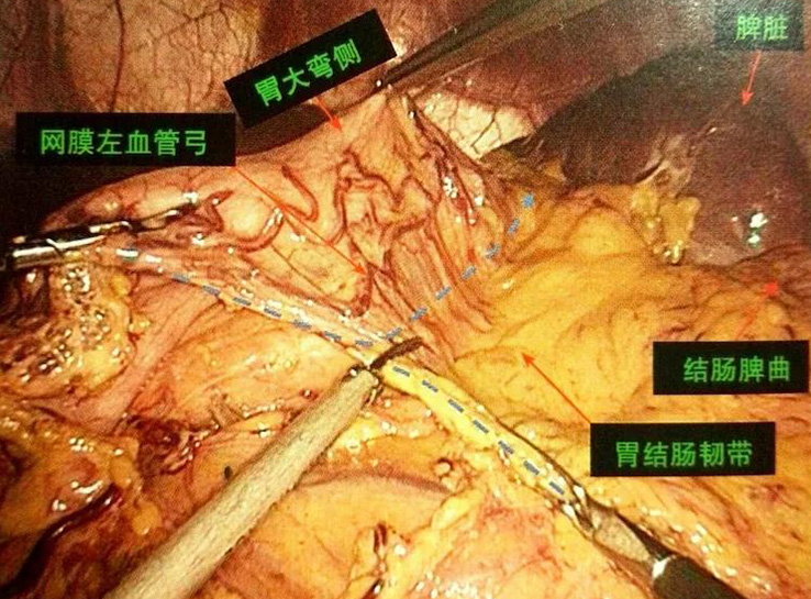 9.6 断胃结肠韧带