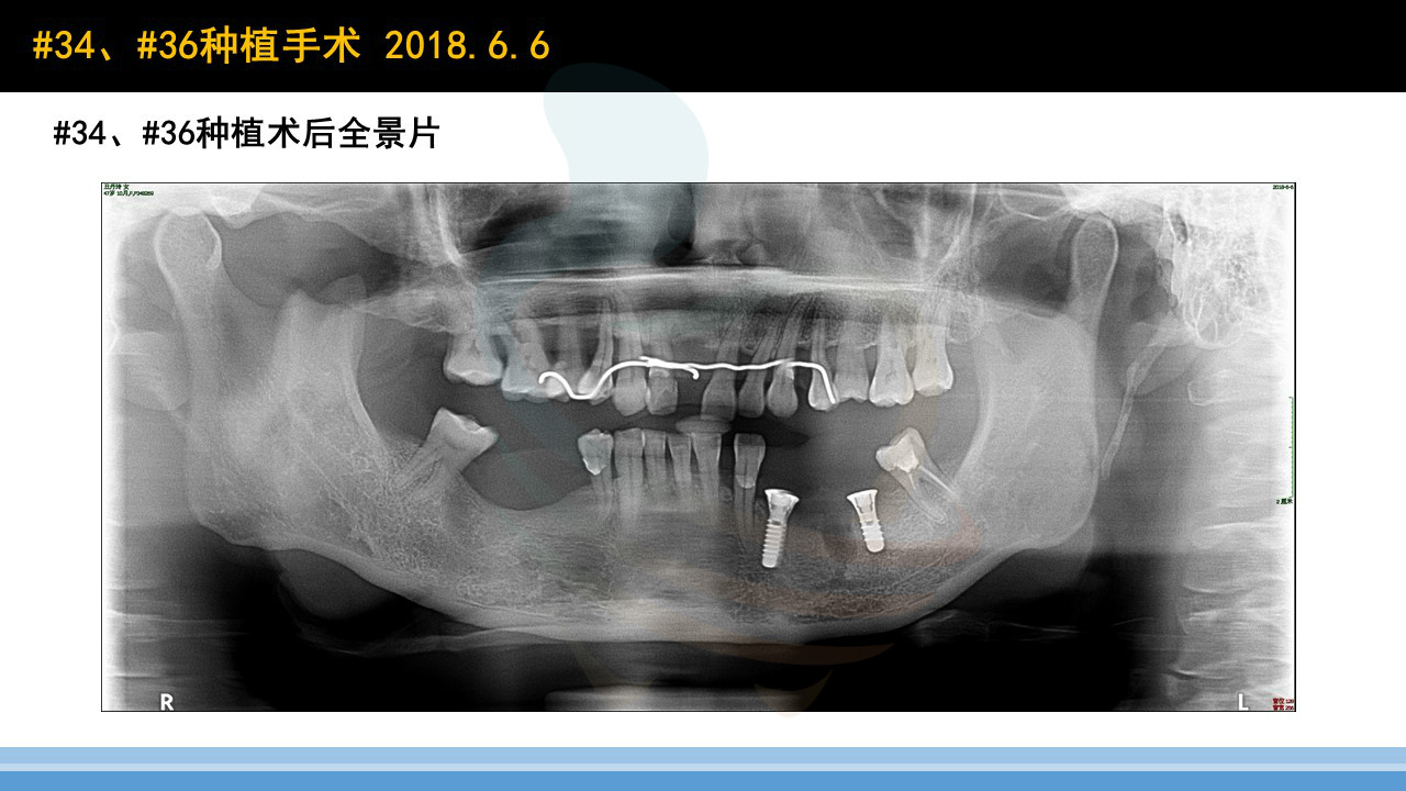 对于过薄牙槽嵴,如采用骨劈开往往需同时联合引导骨再生植骨技术,保护