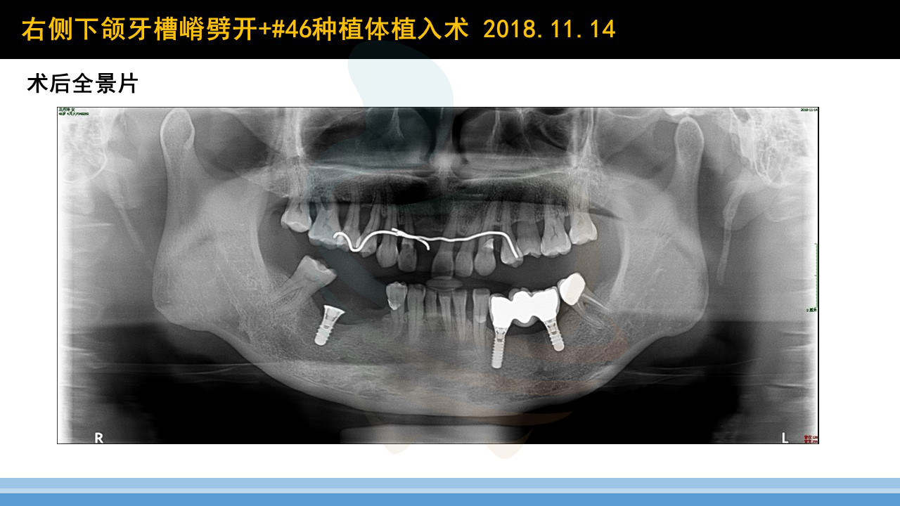 下颌后牙区牙槽嵴劈开术