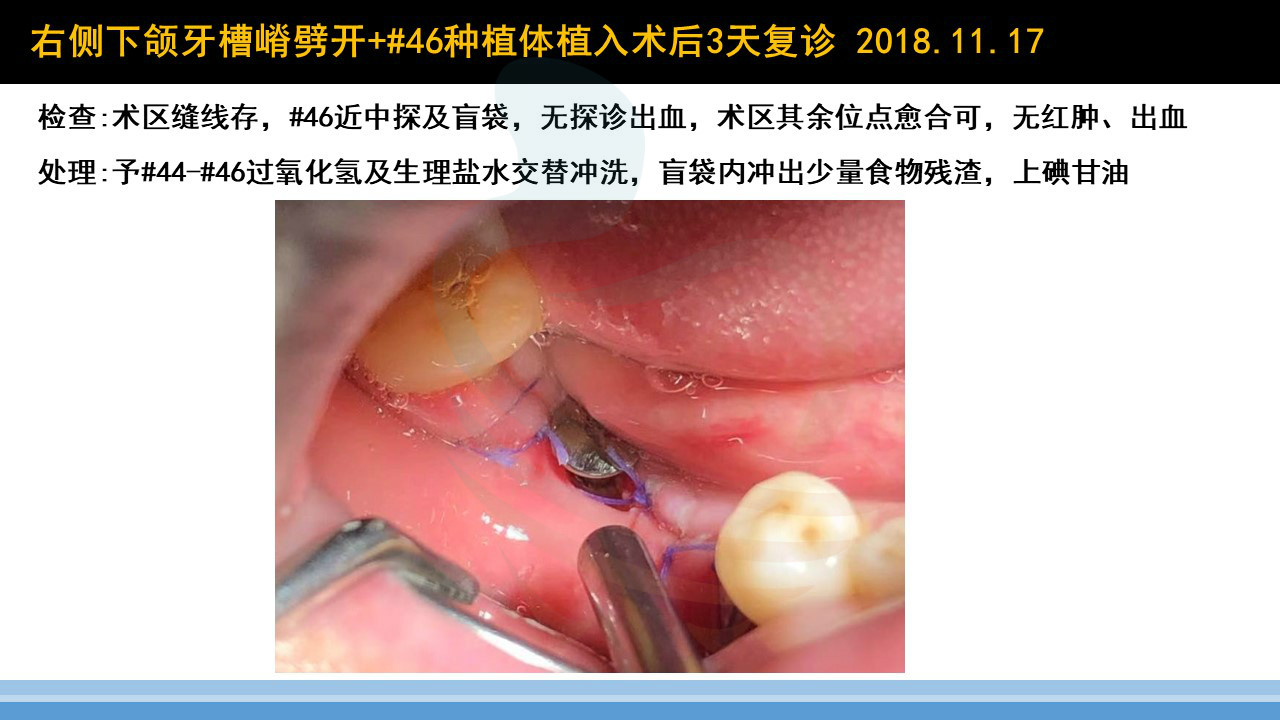 下颌后牙区牙槽嵴劈开术