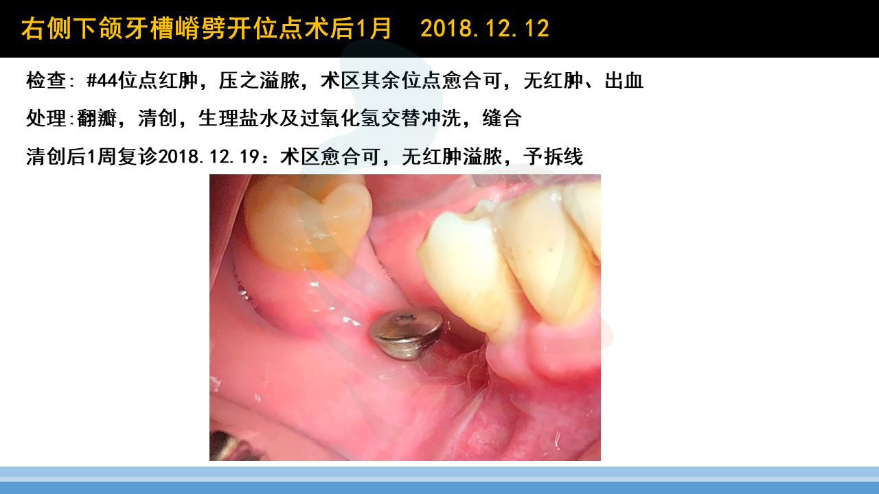 下颌后牙区牙槽嵴劈开术