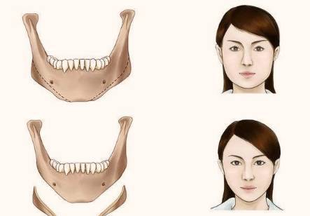 新闻资讯>新闻详情 如果你是属于颧骨下颌角突出明显,但脸上没有