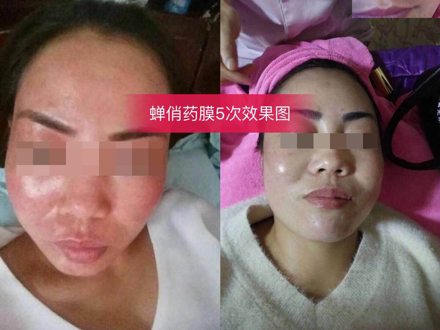 蝉俏对比图 蝉俏 佳人秀中药面膜/佳人秀/中药面膜/药膜/佳人秀肤