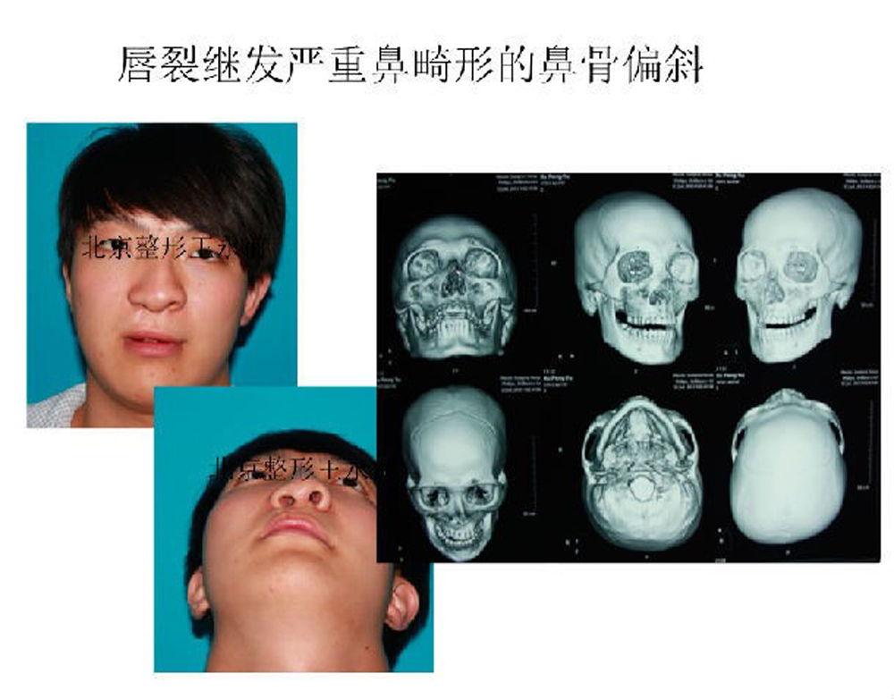 唇鼻肌肉三维重建技术支持下的严重唇裂术后鼻畸形矫正