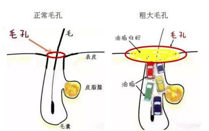 油脂分泌过旺,毛孔堵塞导致的毛孔粗大