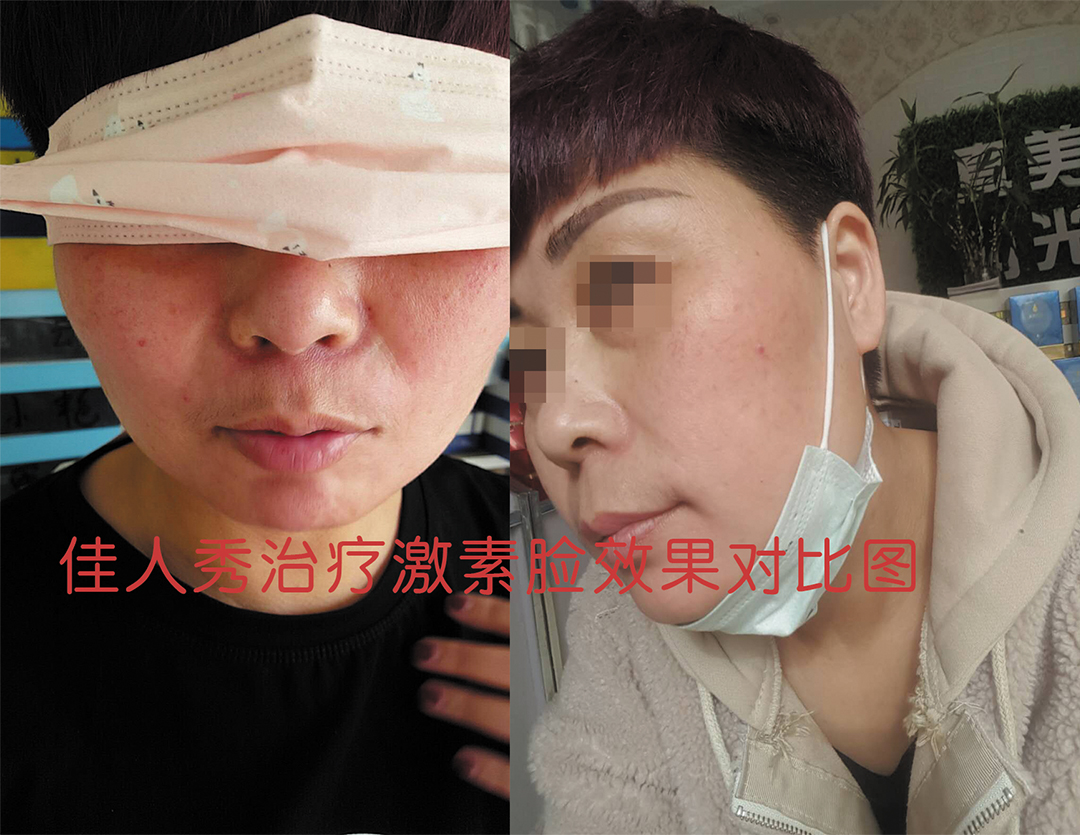 佳人秀中药面膜/佳人秀/中药面膜/药膜/佳人秀肤/静颜佳人秀/佳人秀姿