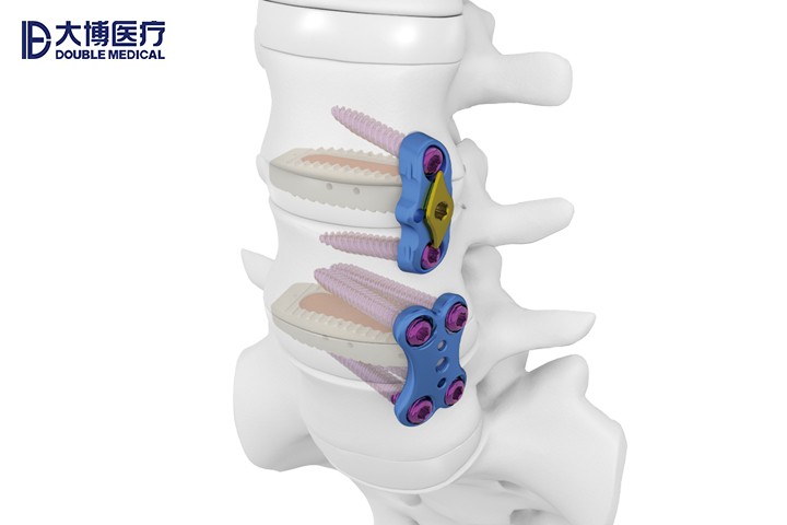 脊柱椎间融合器