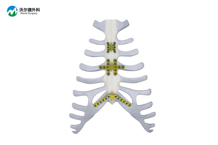 胸壁接骨板、螺钉内固定系统