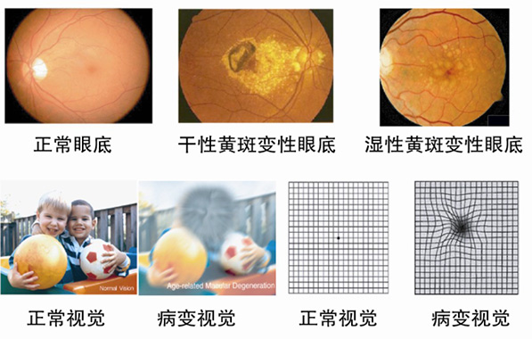 老年人的眼底病主要有哪些? 老年人的眼底病主要有哪些?