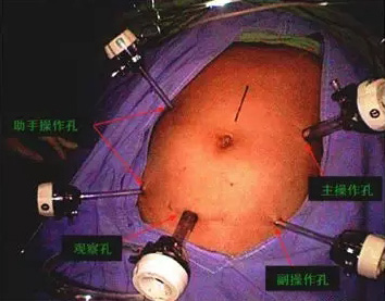 【腹腔镜篇】结直肠癌手术的入路图解 【腹腔镜篇】结直肠癌手术的入路图解