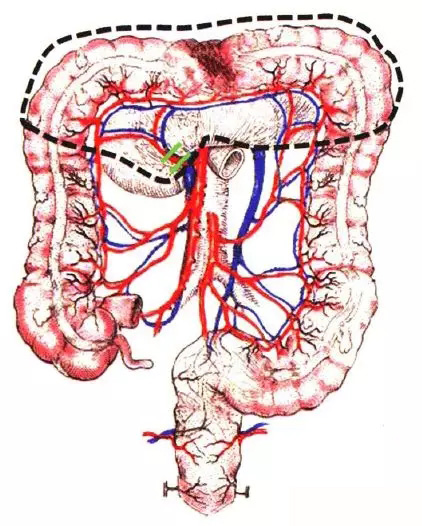 【腹腔镜篇】结直肠癌手术的入路图解 【腹腔镜篇】结直肠癌手术的入路图解
