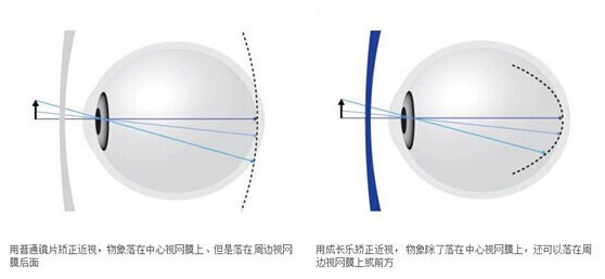 医学配镜 医学配镜