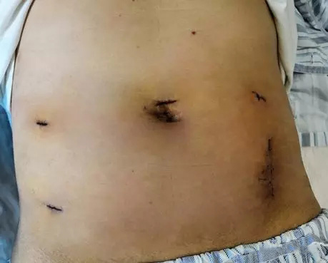 【腹腔镜篇】结直肠癌手术的入路图解 【腹腔镜篇】结直肠癌手术的入路图解