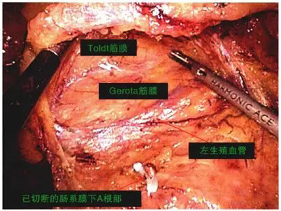 【腹腔镜篇】结直肠癌手术的入路图解 【腹腔镜篇】结直肠癌手术的入路图解