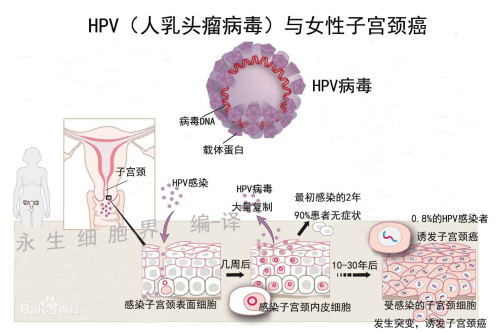 研究發(fā)現(xiàn)尿檢可檢HPV 準(zhǔn)確性比宮頸抹片更高