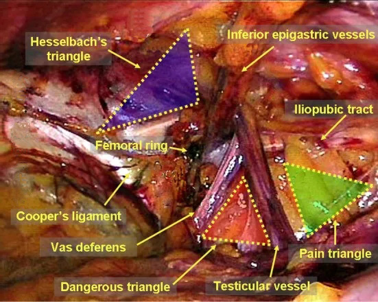 doom):由精索血管和輸精管圍成的三角形,兩者在內環口會合,進入腹股溝