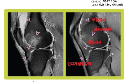 临床实验：《患者服用II型胶原蛋白三个月前后核磁共振对比》