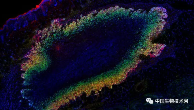 Science大发现：超声波“看”到肿瘤细胞打开了基因...