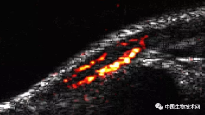 Science大发现：超声波“看”到肿瘤细胞打开了基因...