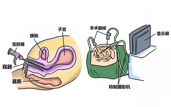【宫腔镜科普】女性健康守护神 【宫腔镜科普】女性健康守护神