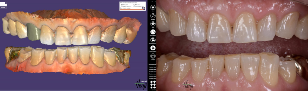 美迪特重拳出击 | 三星、奔驰、华为使用的3D扫描仪技术进入牙科行业了！