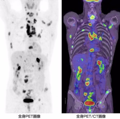 癌症筛查方法大全