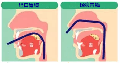 日本鼻胃镜—真正的无痛胃镜