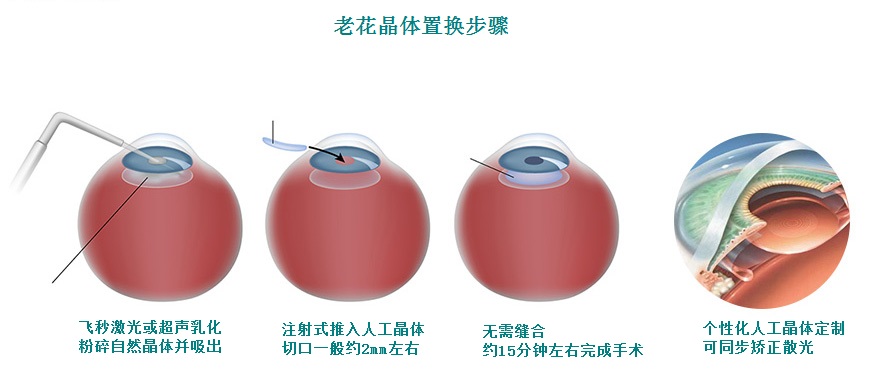 欧洲老花治疗技术 欧洲老花治疗技术