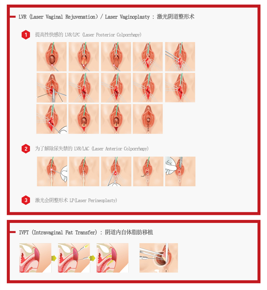 阴道松弛症