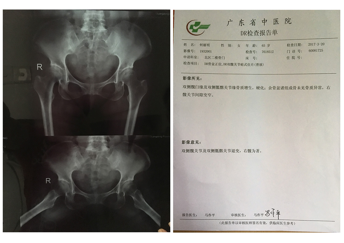 髋关节退行病变 髋关节退行病变
