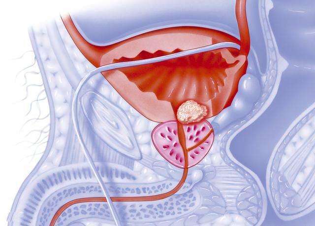 男人50岁后应定期体检，否则前列腺癌找上门！