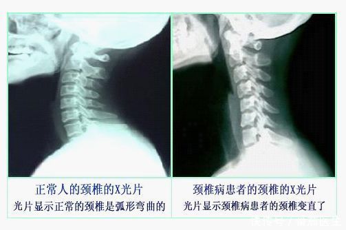 哪些不良习惯能够导致颈椎病 哪些不良习惯能够导致颈椎病