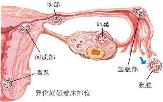 妇科泡沫剂OEM学术：造成异位妊娠的原因有哪些？