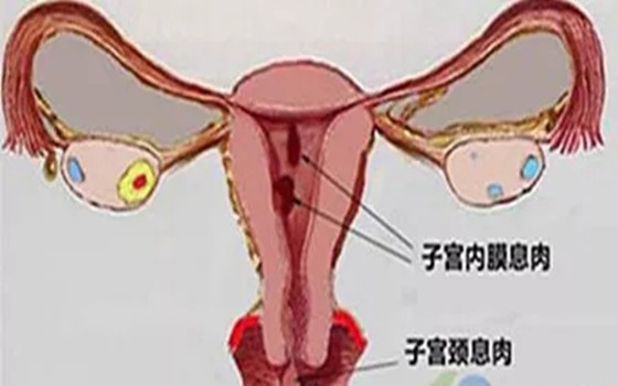 婦科凝膠廠家分析  宮頸息肉到底有多可怕？