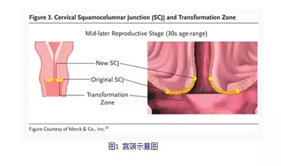 婦潔抑菌凝膠學(xué)術(shù)  一個(gè)過(guò)時(shí)的婦科疾病---宮頸糜爛