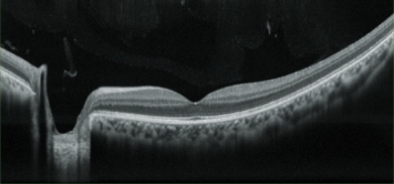 RS-330眼科光学相干断层扫描仪