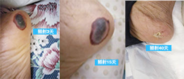 86岁褥疮老人的奇迹康复 ——全科治疗仪是家庭医生的好助手 86岁褥疮老人的奇迹康复 ——全科治疗仪是家庭医生的好助手