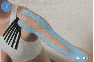 kinesio 之凝肩篇：过度使用手腕引起的肩部不适