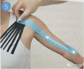 kinesio 之凝肩篇：过度使用手腕引起的肩部不适