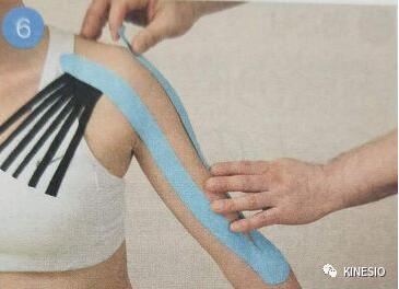 kinesio 之凝肩篇：过度使用手腕引起的肩部不适