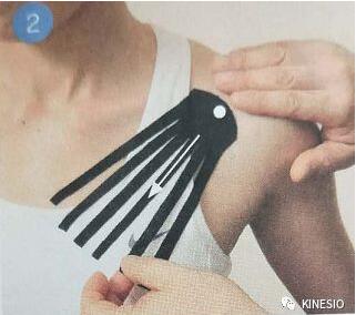 kinesio 之凝肩篇：过度使用手腕引起的肩部不适