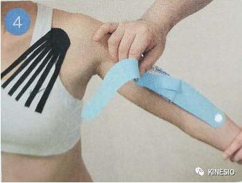 kinesio 之凝肩篇：过度使用手腕引起的肩部不适