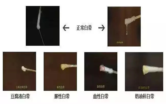 经前白带增多正常吗？