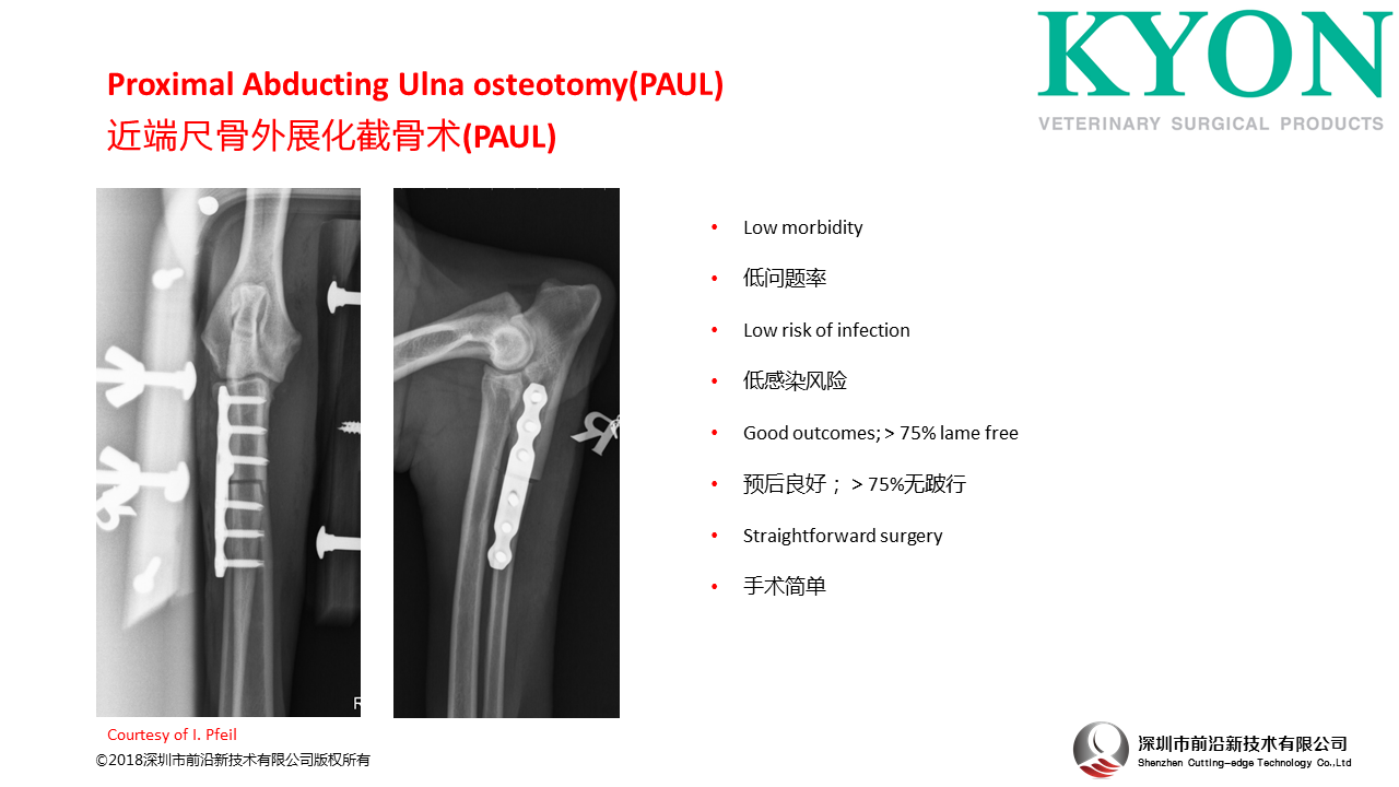瑞士Kyon Proximal Abducting Ulna osteotomy(PAUL)近端尺骨外展化截骨术PAUL