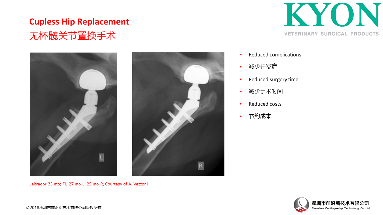 瑞士Kyon Cupless Hip Replacement 无杯髋关节置换手术