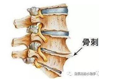 这还是我们认识的“骨刺”吗?骨质增生新旧观点大更迭 这还是我们认识的“骨刺”吗?骨质增生新旧观点大更迭